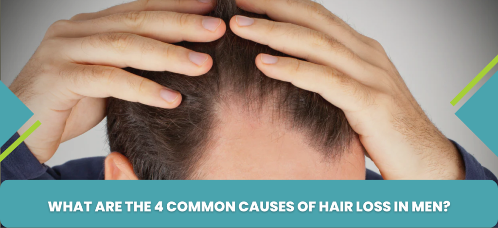 What are the 4 Common Causes of Hair Loss in Men