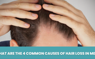 What are The 4 Common Causes of Hair Loss in Men?
