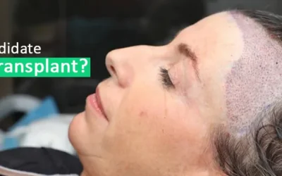 Are women the right candidate for a hair transplant?
