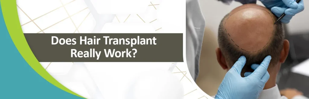 Does Hair Transplant Really Work?