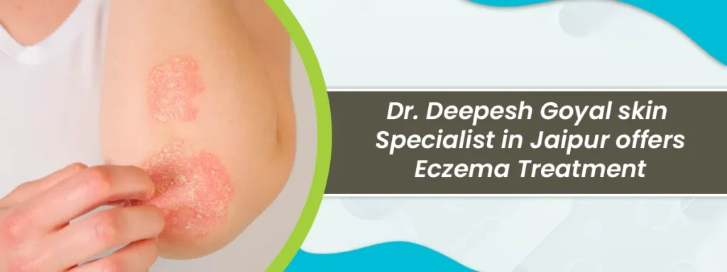 eczema treatment