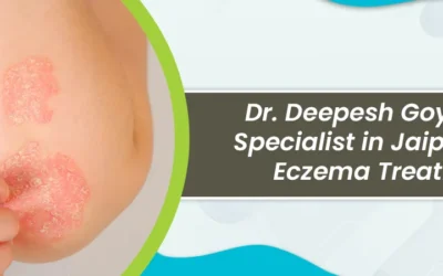 Dr. Deepesh Goyal skin specialist in Jaipur offers Eczema Treatment