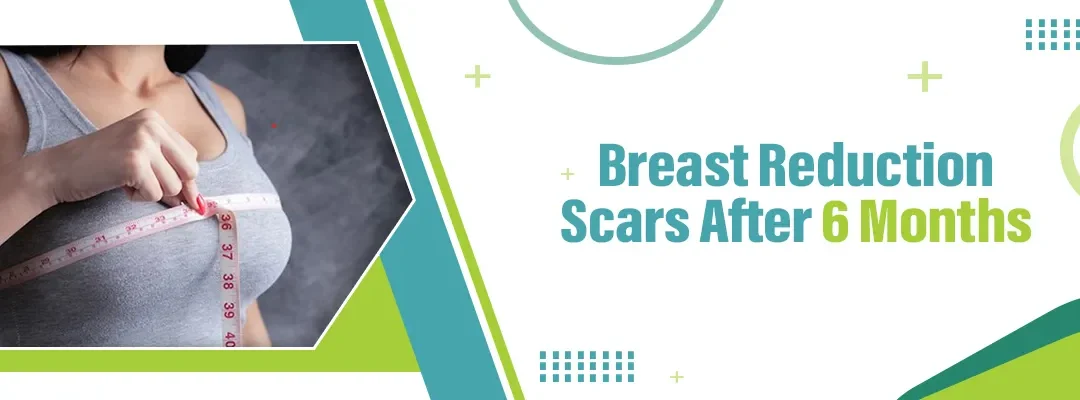 Breast Reduction Scars After 6 Months