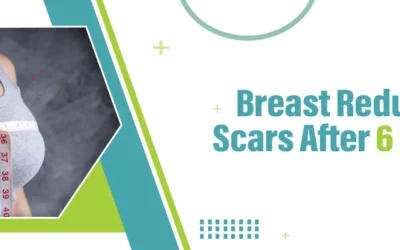 Breast Reduction Scars After 6 Months