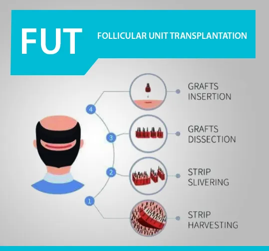 FUT Hair Transplant in Jaipur