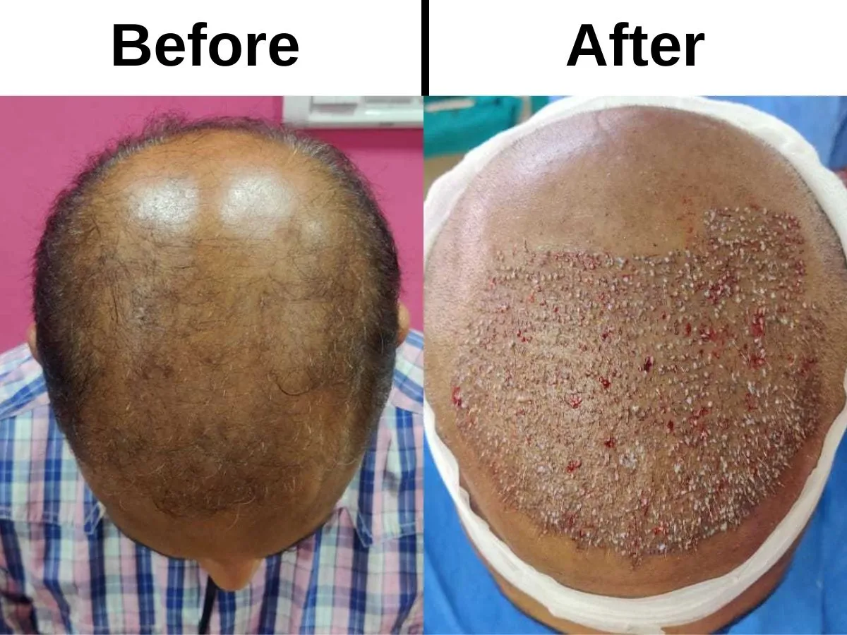 FUT plus FUE DHI hair transplant treatment in Jaipur to stage 7 baldness