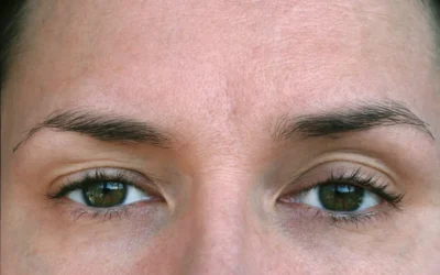 Frontalis Sling For Ptosis