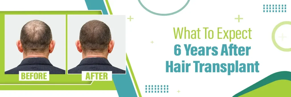 What to Expect 6 Years after Hair Transplant