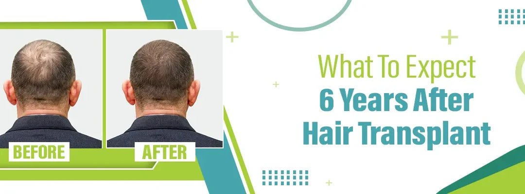 What to Expect 6 Years after Hair Transplant