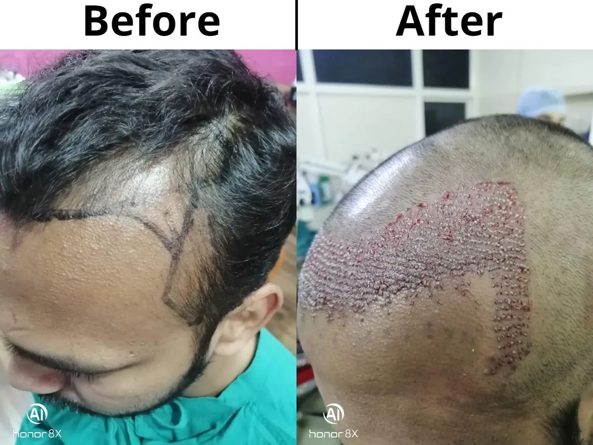 Hair loss in the hairline area and sides treated with FUE hair transplant in Jaipur
