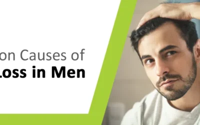 4 Common Causes of Hair Loss in Men