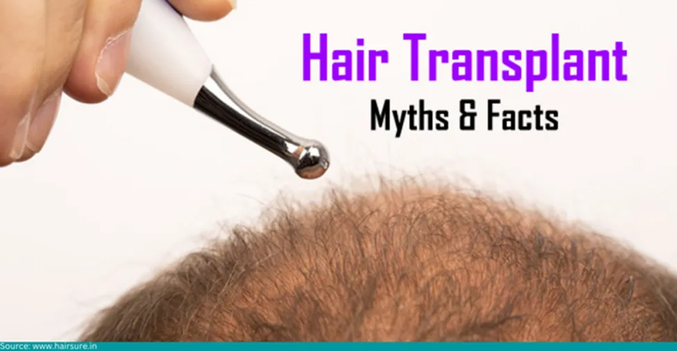 Hair Transplant Myths & Facts