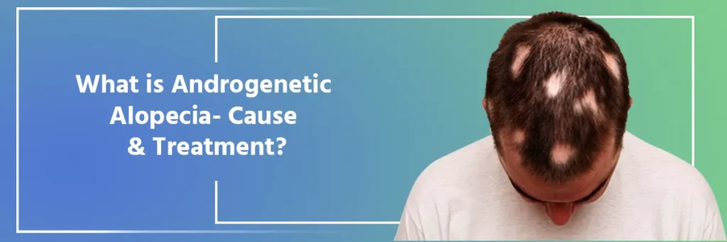 Androgenetic Alopecia Treatment