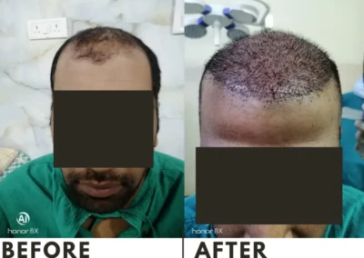 Baldness Treated with a Combo of FUE & FUT Hair Transplant in Jaipur