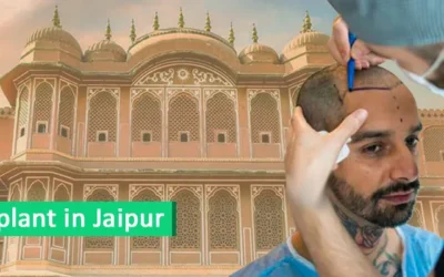 EMI facility for hair transplant in Jaipur