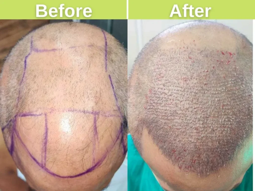 FUT, FUE and DHI hair transplant