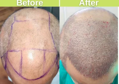 FUT, FUE and DHI hair transplant with 4274 hair grafts