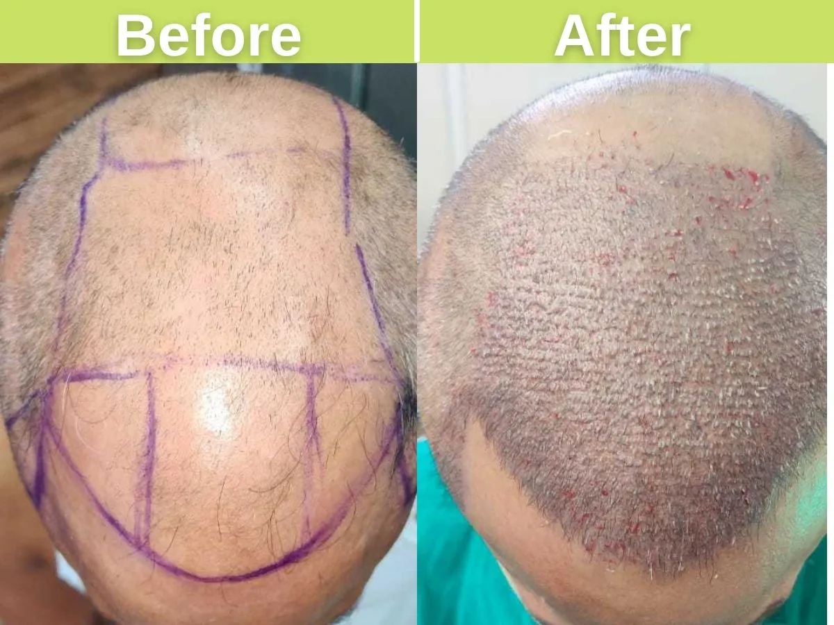 FUT, FUE and DHI hair transplant with 4274 hair grafts