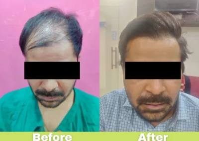 More than 4000 hair grafts hair transplant treatment done by FUT method