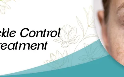 Freckle control & Treatment