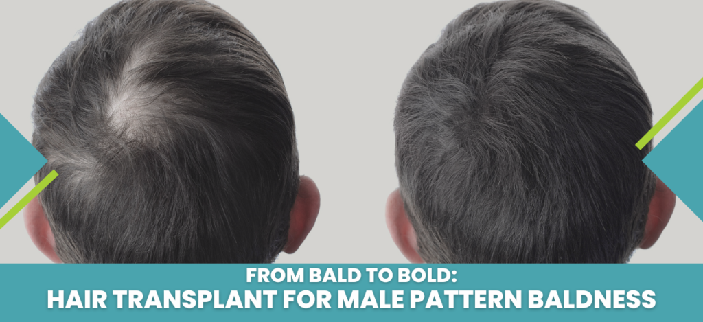 Hair Transplant for Male Pattern Baldness