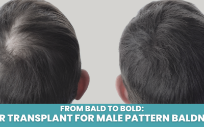 From Bald to Bold: Hair Transplant for Male Pattern Baldness