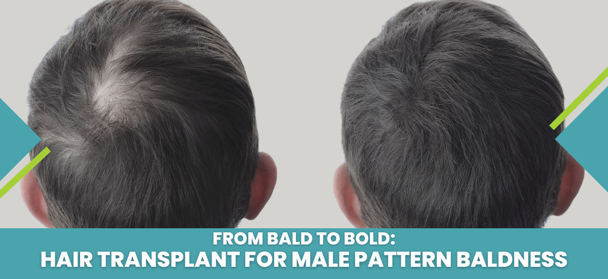 Hair Transplant for Male Pattern Baldness