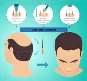 How is the Direct Hair Transplantation (DHT) Performed