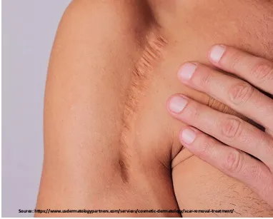 Long or irregular scars