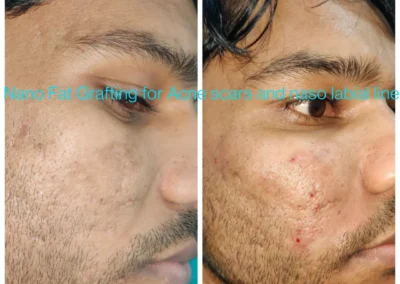 Micro Fat Grafting for Reduction of Depressed Acne Scars and Deepen Nasolabial Folds