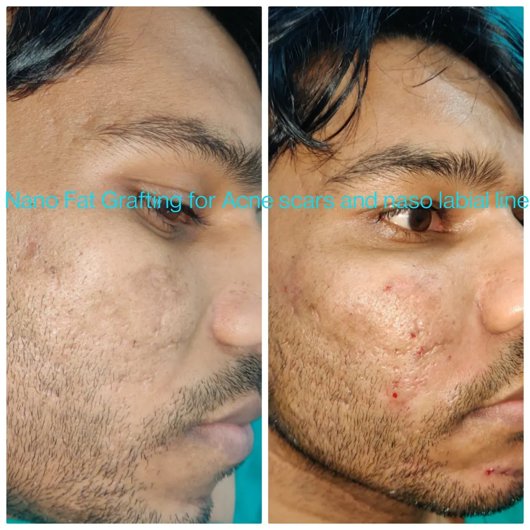 Micro Fat Grafting for Reduction of Depressed Acne Scars and Deepen Nasolabial Folds