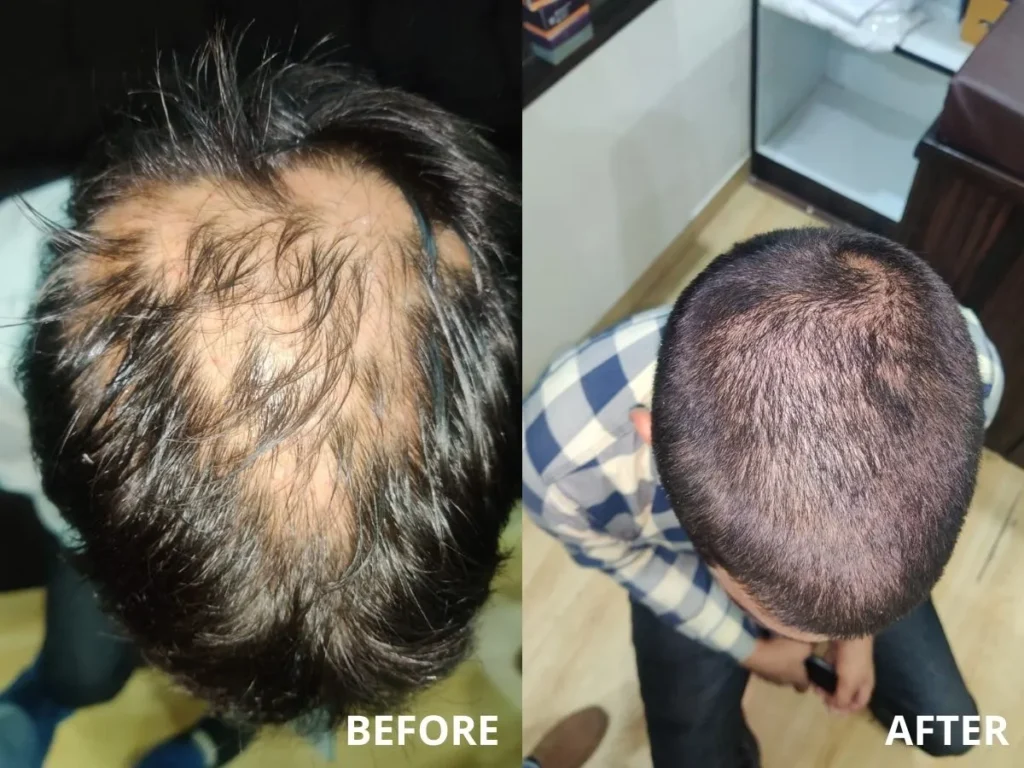 Treatment of Alopecia Areata with Steroid Injections and PRP Therapy