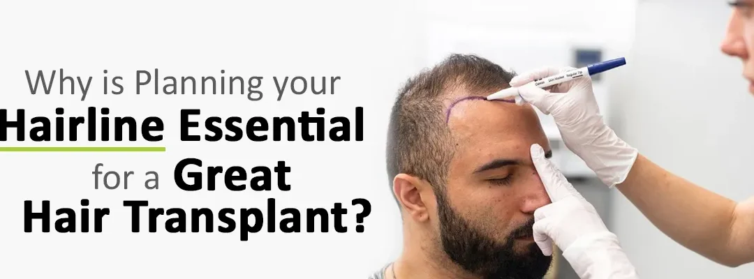 Why is Planning your Hairline Essential for a Great Hair Transplant?
