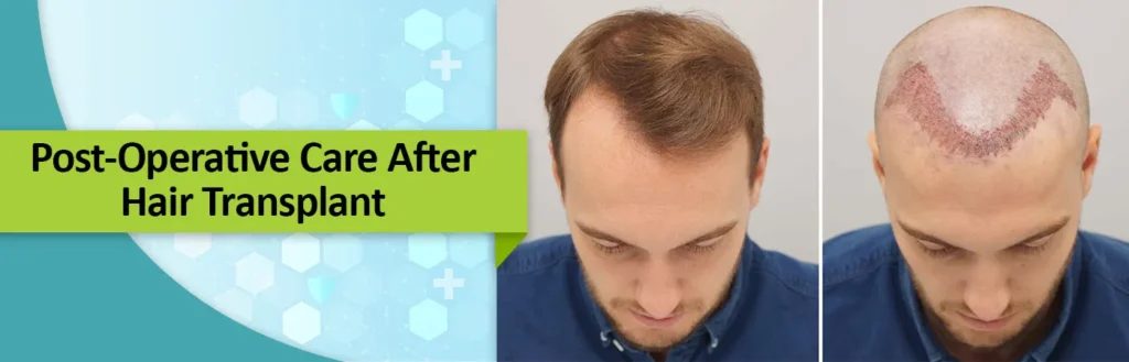 Post-Operative Care After Hair Transplant