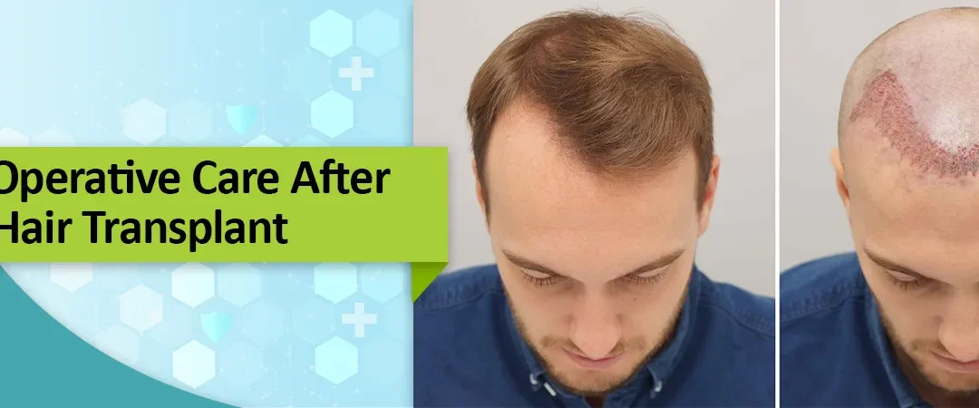 Post-Operative Care After Hair Transplant