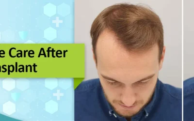Post-Operative Care After Hair Transplant
