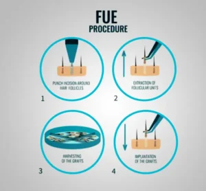 Step by step FUE procedure