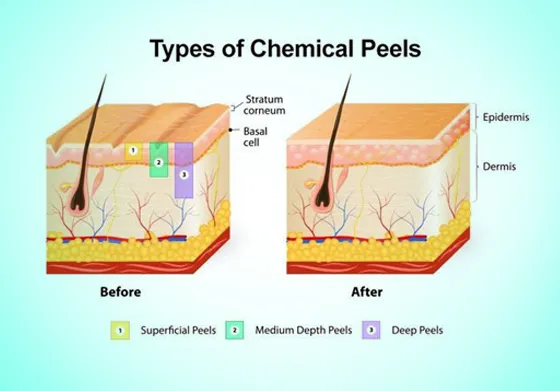 Types of Chemical Peelings