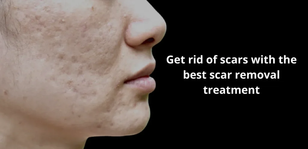 best scar removal