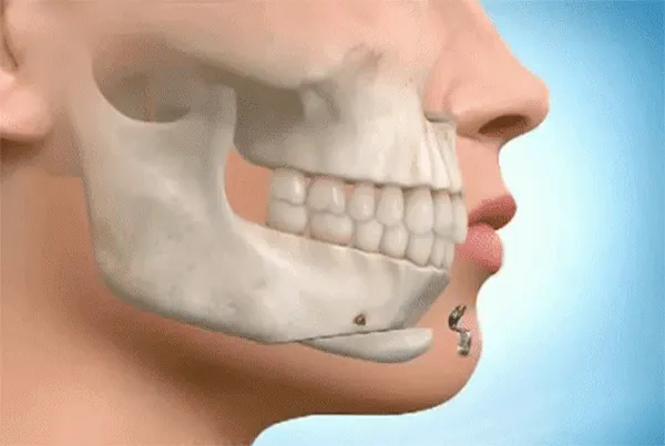 chin surgery