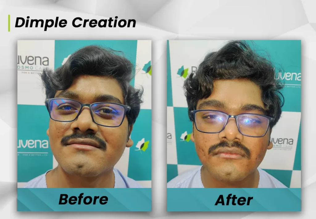 Before and After - Avinash