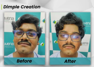dimple creation surgery - Male