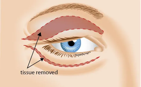 eyelid tissue