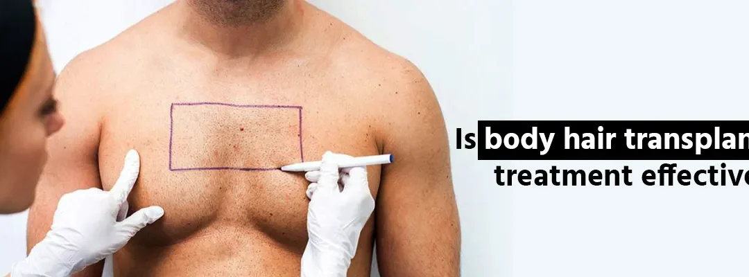 Is body hair transplant treatment effective?