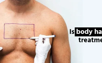 Is body hair transplant treatment effective?