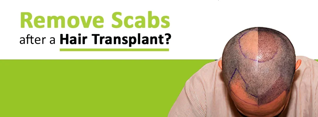 How can you remove Scabs after a Hair Transplant?