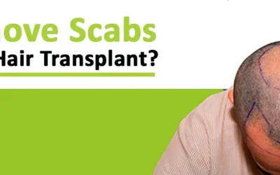 How can you remove Scabs after a Hair Transplant?