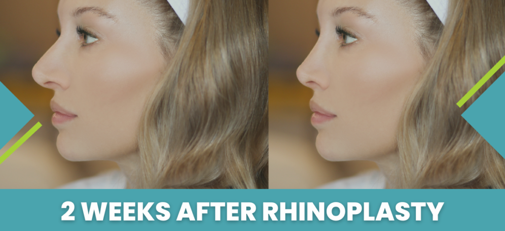 2 Weeks After Rhinoplasty