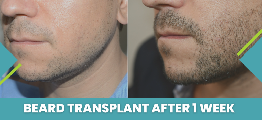 Beard transplant after 1 week