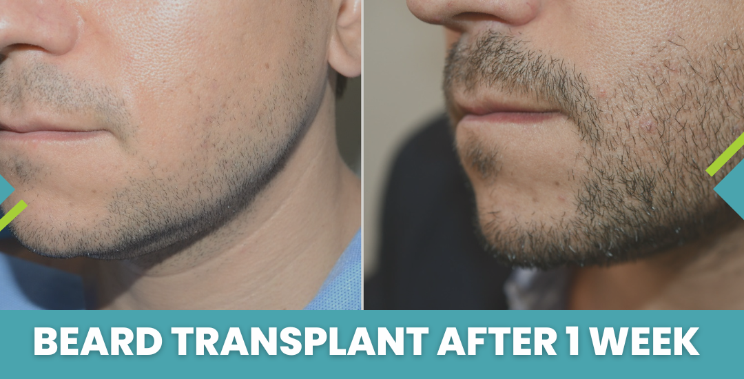 Beard transplant after 1 week